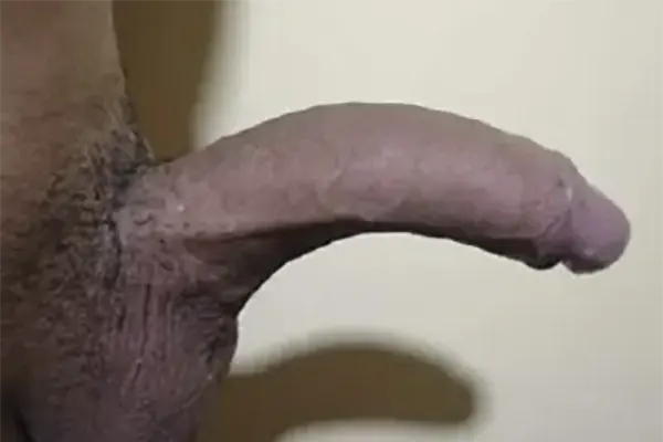 Curvatura Congenita Pre operatorio.