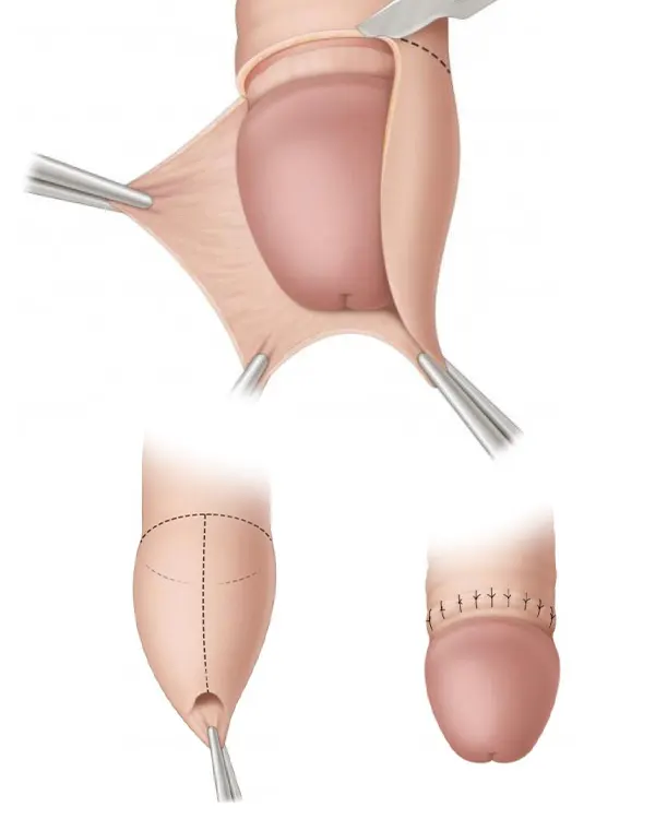 img-circuncision-en-bogota-1