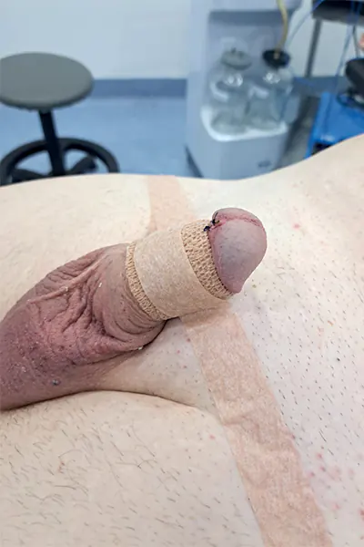 Img-Clínica_del_Hombre-Circuncision-en-bogota-2 Img-Clínica_del_Hombre-Circuncision-en-bogota-2