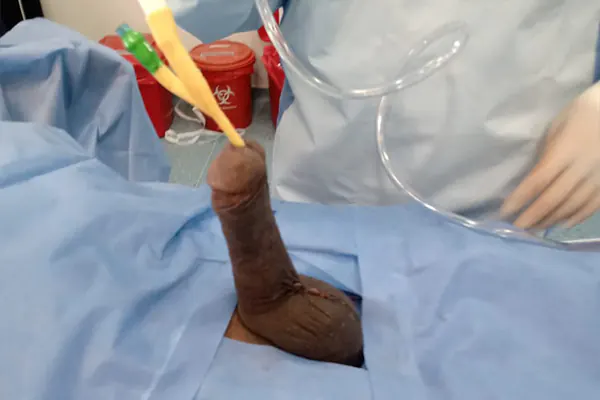 Img-Clínica_del_Hombre-Prótesis_de_Pene_Maleable-PosOperatorio_Inmediato-2 Img-Clínica_del_Hombre-Prótesis_de_Pene_Maleable-PosOperatorio_Inmediato-2