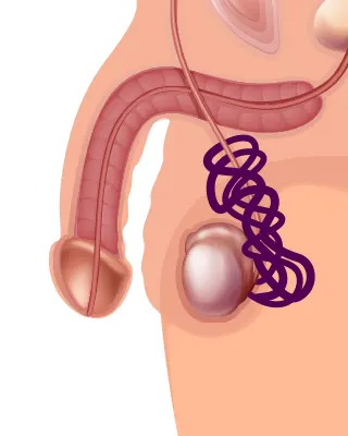 Img-Clínica_del_Hombre-Servicios-Hidrocelectomía-LCP