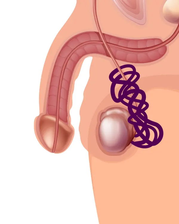 Img-Clínica_del_Hombre-Servicios-Hidrocelectomía