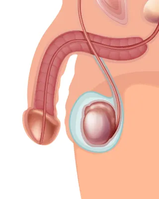 Img-Clínica_del_Hombre-Servicios-Varicocelectomía-LCP